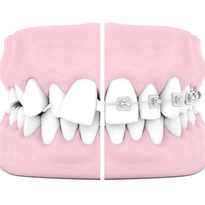 Dental braces