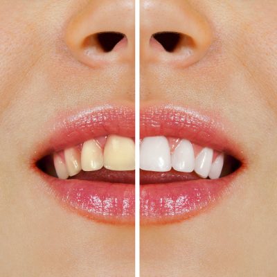 woman teeth before and after whitening
